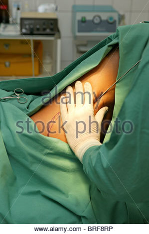 operacija nugaros riebalams pašalinti